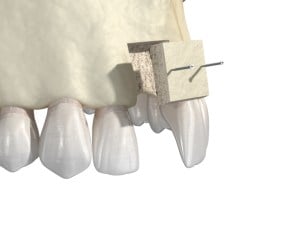 Illustration of bone being grafted